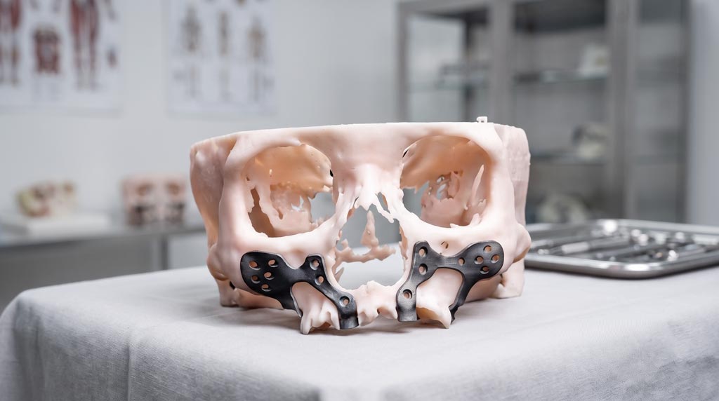 CTARS PSI maxillofacial implant