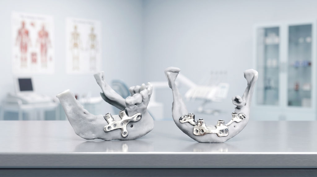 CTARS PSI titanium implant